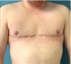 A woman who has had her breasts surgically removed as part of sex-transition surgery.  (Getty Images)  